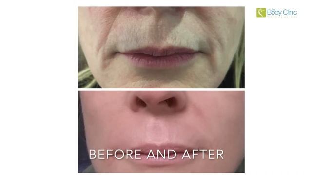 PLASMA PEN | Non-Surgical Eyelid Reduction | Wrinkle Treatment смотреть онлайн