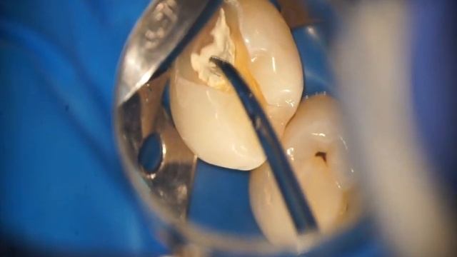 Пряме покриття пульпи. Відкритий ріг пульпи - полікарбоксилатний цемент Адгезор Карбофайн. смотреть онлайн