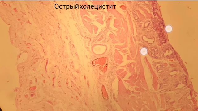 Острый холецистит смотреть онлайн
