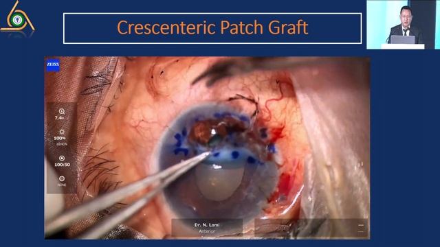 AIOC2024 - IC365 - Dr.Radhika Tandon - Peripheral Ulcerative Keratitis: Evidence-based strategies.. смотреть онлайн
