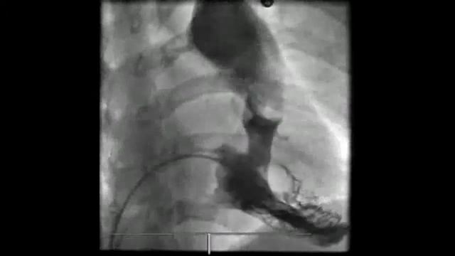 Cath Case: Pulmonary Stenosis (PS) on ventriculography #cardiology #cath #diagnosis смотреть онлайн