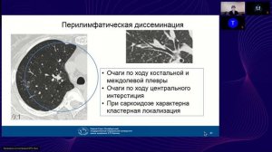 Очаги в легких - возможности и ограничения при КТ