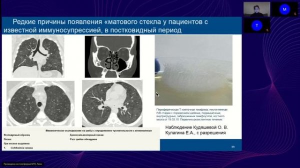 Симптом "матового стекла" на КТ - что это значит?