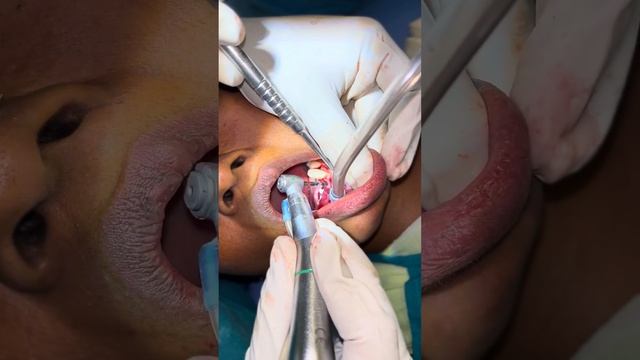 Slim line implant in narrow Ridge -Dr chethan # Nagu # channapatana смотреть онлайн