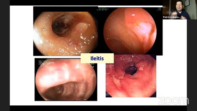Enfermedad inflamatoria desde el punto de vista endoscópico смотреть онлайн