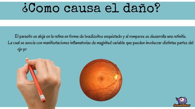 Toxoplasmosis ocular 2 смотреть онлайн