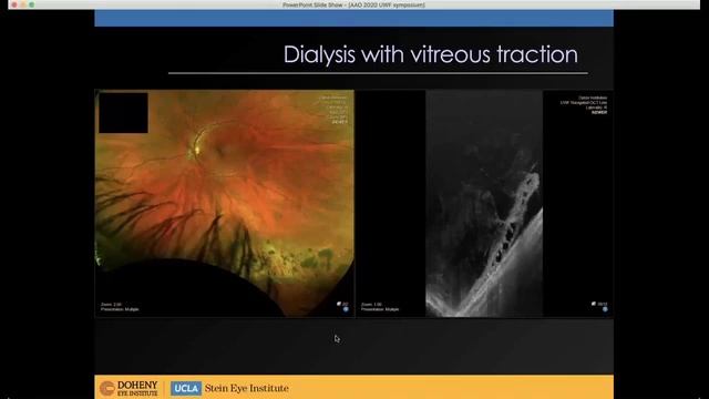 Evolution and Advances in UWF Imaging смотреть онлайн