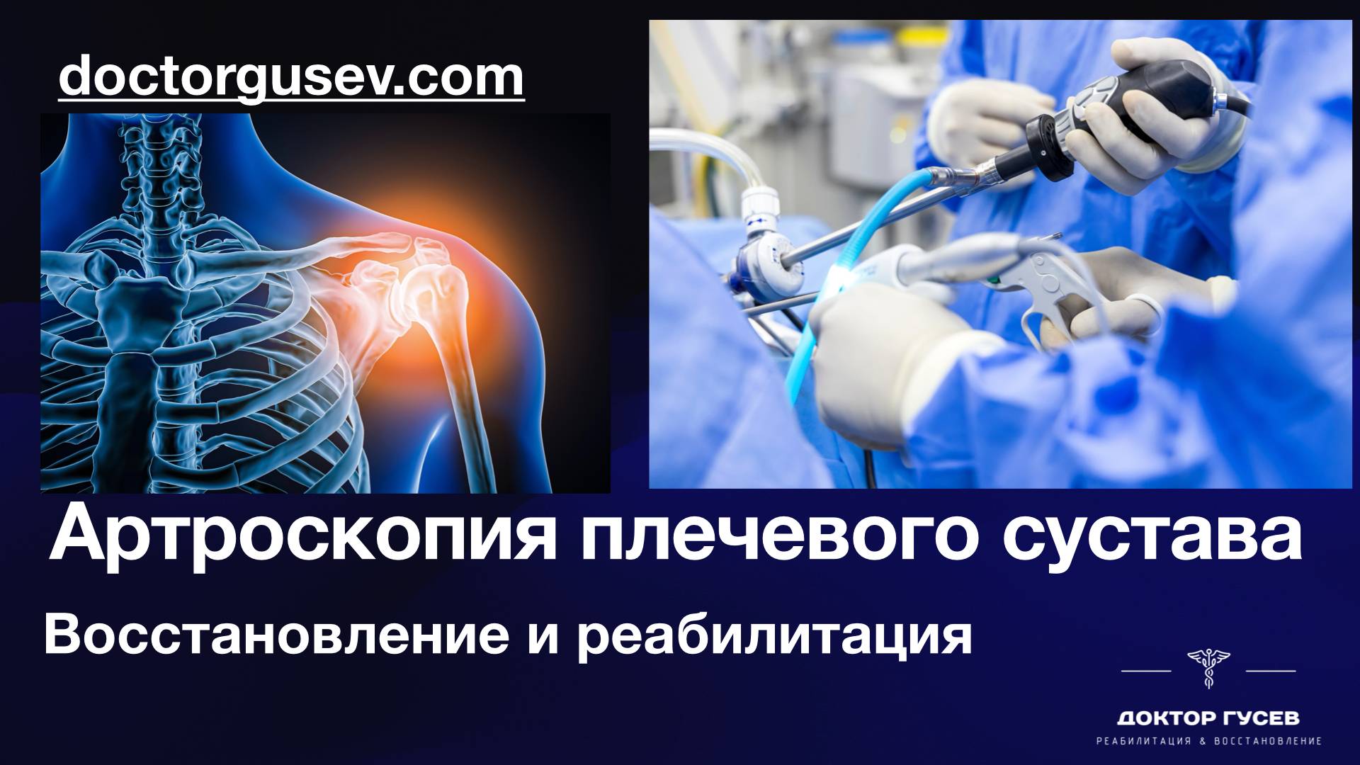 Восстановление после артроскопии плечевого сустава смотреть онлайн