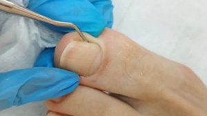 Врастающий ноготь или подногевая мозоль?