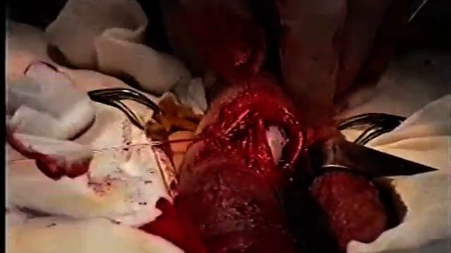 Имплантация пенильных протезов. Красулин В.В. смотреть онлайн