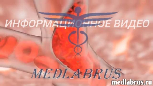 Ишемический инсульт и его лечение смотреть онлайн