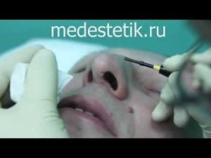 Удаление новообразований Сургитроном