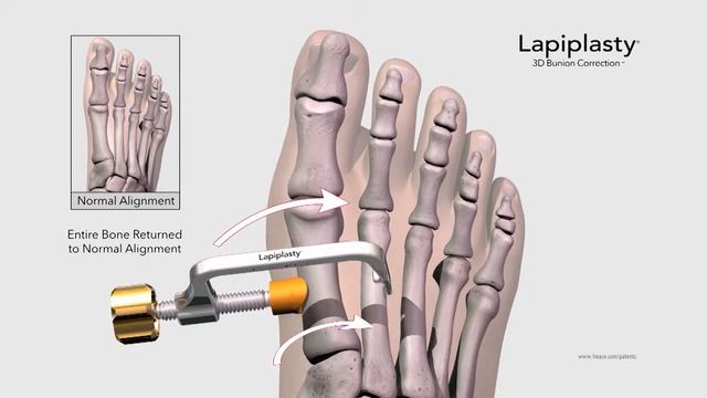 Changing Bunion Correction For Good