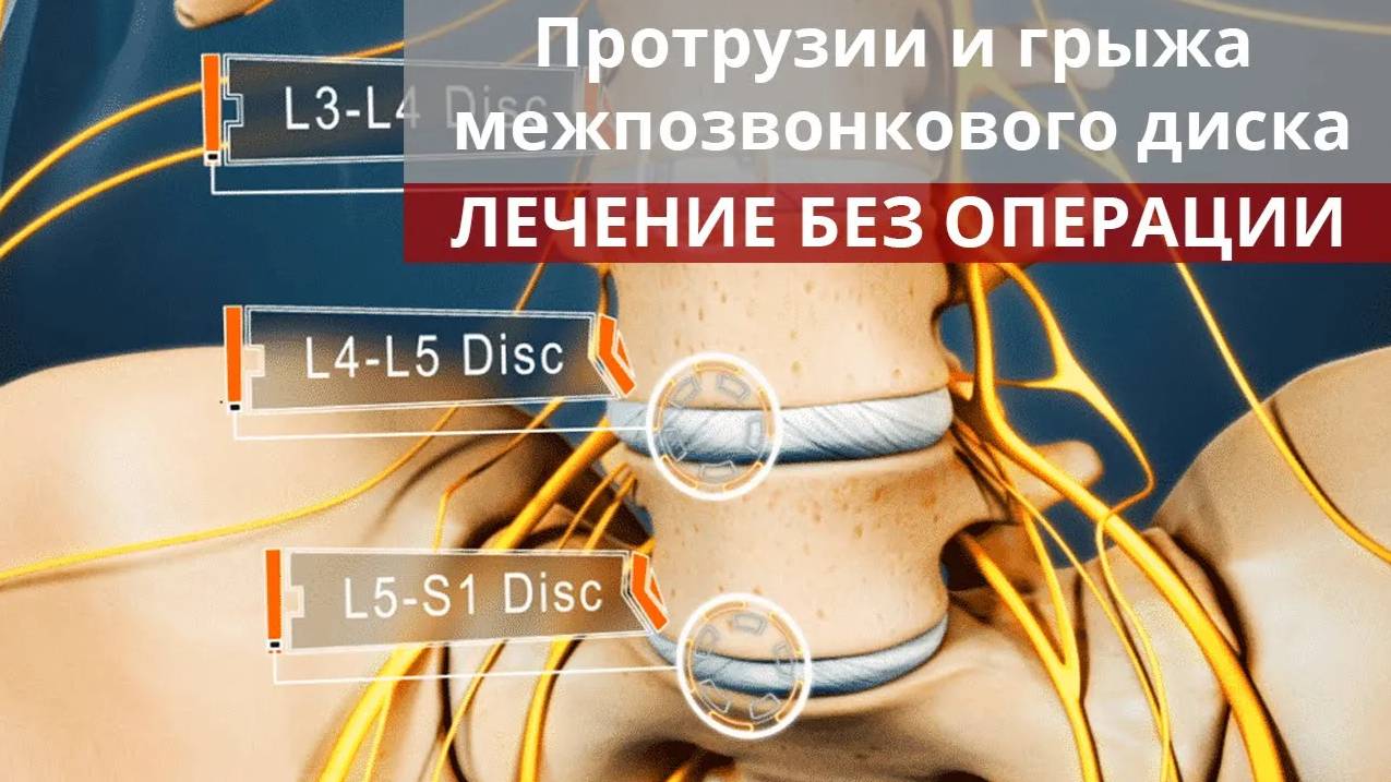 Протрузии и грыжа межпозвонкового диска. Лечение без операции. смотреть онлайн
