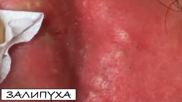 ПРЫЩИ ВЫДАВЛИВАНИЕ 😍  ВЫДАВЛИВАНИЕ ПРЫЩЕЙ 😍 ВЫДАВЛИВАНИЕ ЧЕРНЫХ ПРЫЩЕЙ #acne #прыщи #asmr