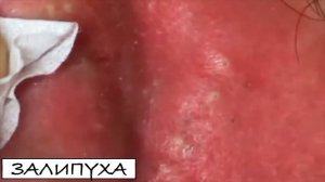 ПРЫЩИ ВЫДАВЛИВАНИЕ 😍  ВЫДАВЛИВАНИЕ ПРЫЩЕЙ 😍 ВЫДАВЛИВАНИЕ ЧЕРНЫХ ПРЫЩЕЙ #acne #прыщи #asmr