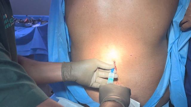 Epidural steroid injection for lower back pain смотреть онлайн
