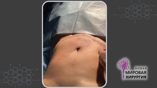 абдоминопластика с переносом пупка смотреть онлайн