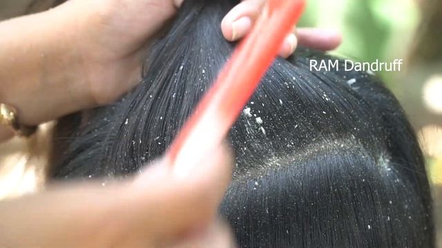 Enjoy Dandruff Scratching On Long Hair Guys