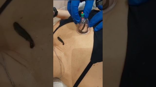 Гирудотерапия у пациентки с сахарным диабетом 1 типа. снижение глюкозы с 10.7 до 6.7