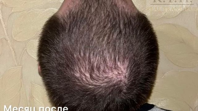 Неделя за неделей: как меняется результат после пересадки волос☀️ смотреть онлайн