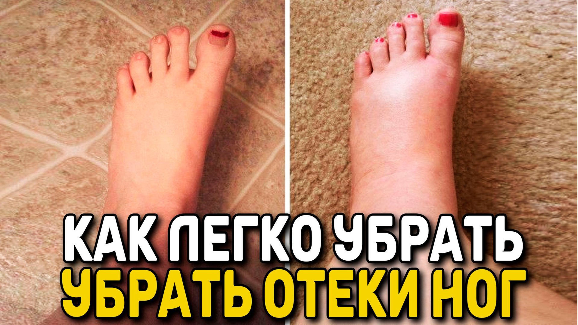 КАК ЛЕГКО УБРАТЬ ОТЕКИ НОГ бабушкиным средством - НАРОДНАЯ МЕДИЦИНА смотреть онлайн