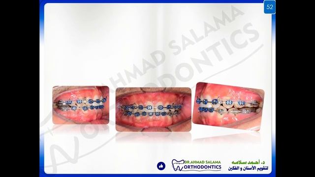 ep27 | class 1 ortho case - part 6 | clinical steps of treatment смотреть онлайн
