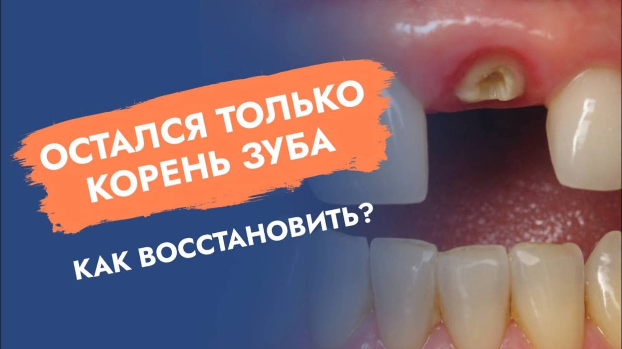 Когда и зачем сохранять корни зубов для протезирования?