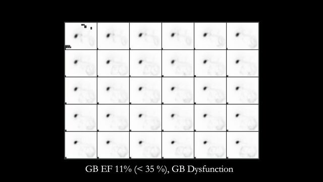 UPJ Obstruction, Chronic Cholecystitis, Multiple NE Tumors смотреть онлайн