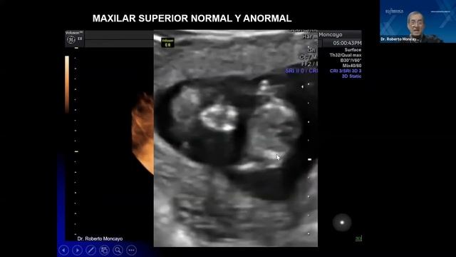 Conferencia 11: ECOGRAFÍA DE LAS 11-14 SEMANAS PARA DESPISTAJE DE CROMOSOMOPATÍAS-GUÍAS ISUOG. смотреть онлайн