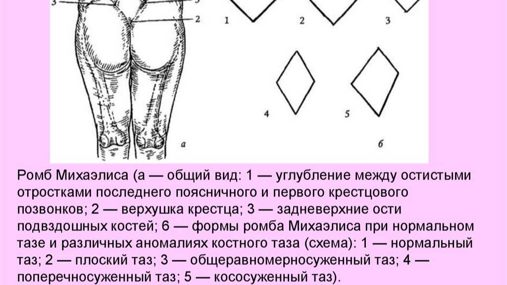 Ромб Михаэлиса смотреть онлайн