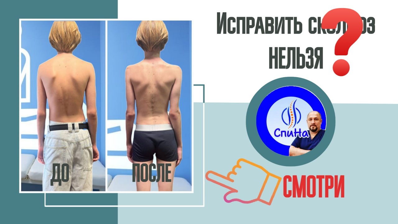 Результат работы со сколиозом #костоправмосква #здоровьеспины #сколиоз #осанка смотреть онлайн