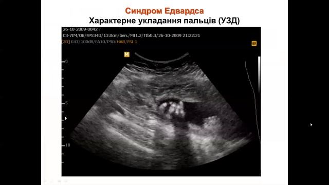 Лекція 2 Хромосомна патологія смотреть онлайн