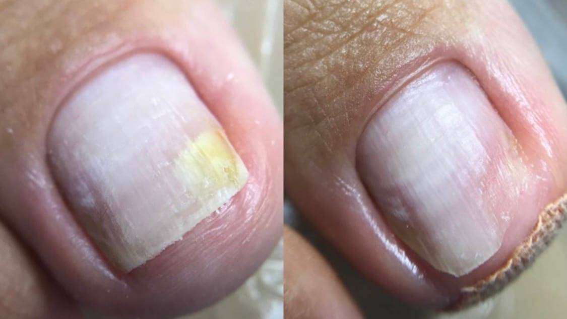 Онихолизис