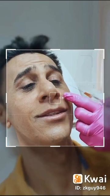 Aplicando preenchedor nas olheiras #preenchimentoolheiras #olheiras #harmonizaçãofacial смотреть онлайн
