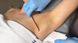 Лазерная эпиляция подмышек – гладкая кожа надолго