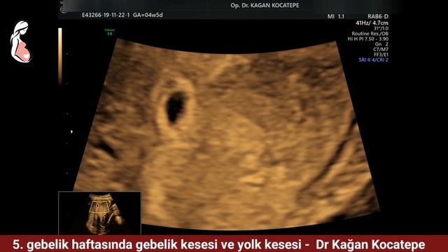 5. gebelik haftasında gebelik kesesi, desidua tabakası, yolk kesesi nasıl ve ne zaman görünür? смотреть онлайн