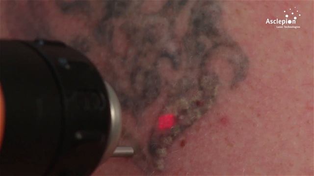 TattooStar - Training video for tattoo removal from Asclepion смотреть онлайн