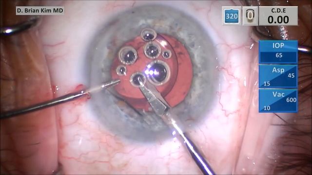 IOL Exchange: Tecnis Multifocal For A Symfony Extended Depth Of Focus Lens