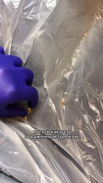 Грибок ногтя. Часть 1 #подология #медицина #лечениеног #грибокногтей смотреть онлайн