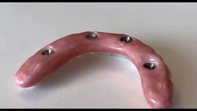 HUGE Failures with All on 4 Dental Implant Bridges смотреть онлайн