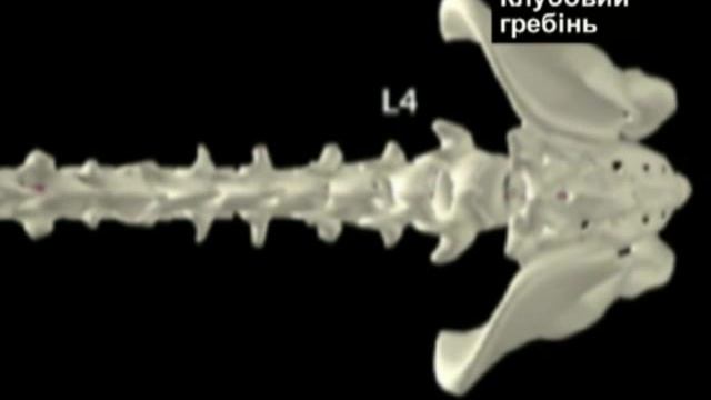 Lumbar-puncture-1.mp4