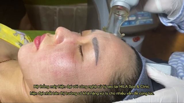 TRỊ SẸO MỤN | FRACTIONAL CO2 LASER | NÊN HAY KHÔNG? смотреть онлайн
