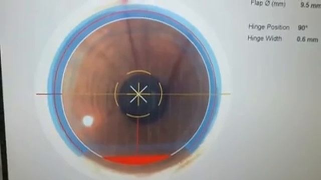 FEMTO LASIK- Blade less removal of glasses-A Dream comes True смотреть онлайн