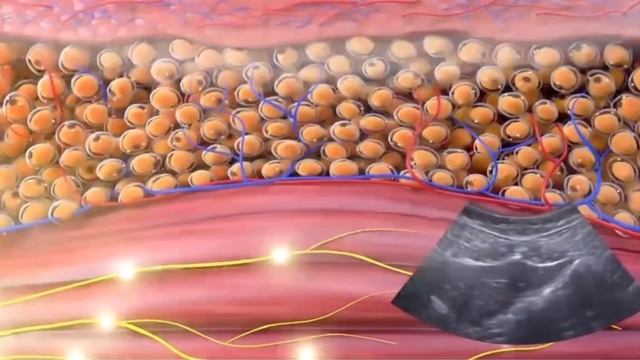 Процедура EMS