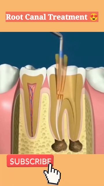 Root Canal Treatment with Crown 👑/Cap 🧢#dental #rct #teeth смотреть онлайн