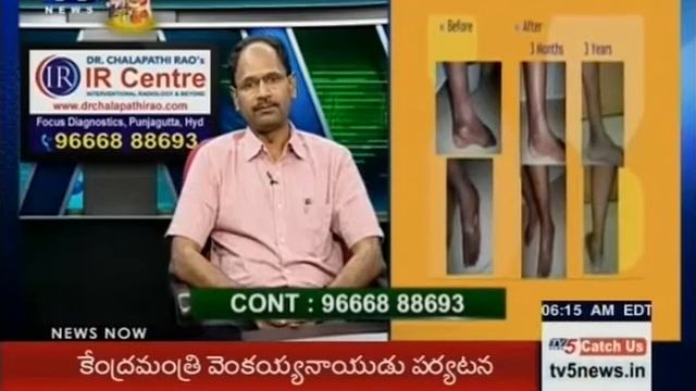 Causes & Treatments For Varicose Veins | Dr Chalapathi Rao's IR Centre | Health File | TV5 News смотреть онлайн