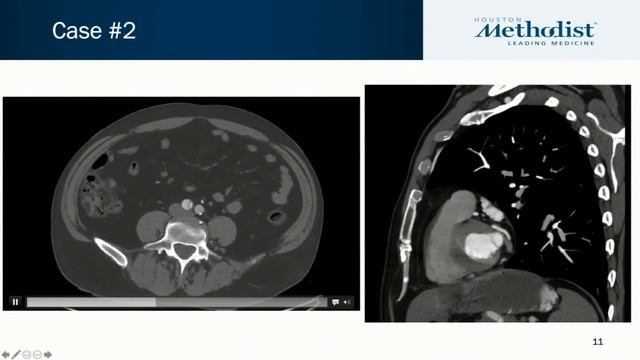 Aortic Dissection (Marvin Atkins, MD; Thomas MacGillivray, MD; Michael Reardon, MD) November 2, 202 смотреть онлайн