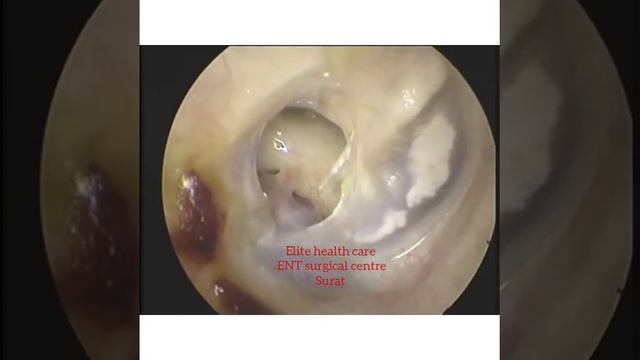Importance of Ear Endoscopy: Middle ear anatomy:jugular bulb смотреть онлайн