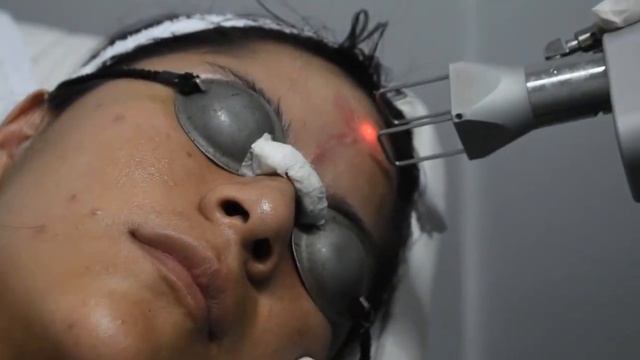 Láser CO2 Fraccionado DEKA para cicatrices de acné - Clínica de la Belleza смотреть онлайн